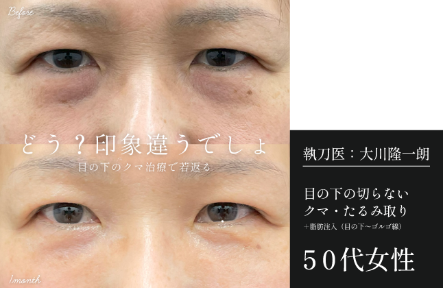 【50代女性】目の下の切らないクマ取り+脂肪注入