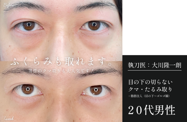 【20代男性】目の下の切らないクマ取り+脂肪注入