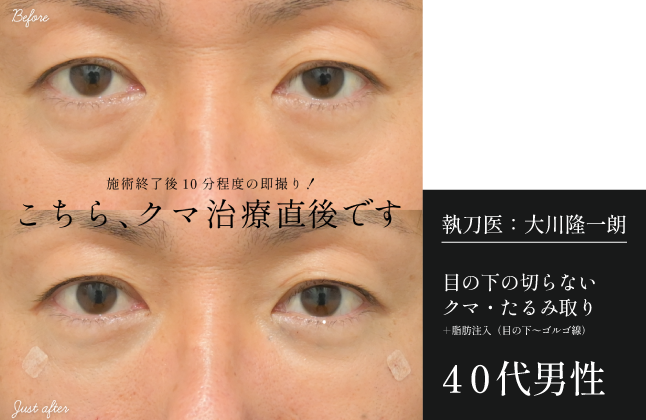 ★施術直後★【40代男性】目の下の切らないクマ取り+脂肪注入