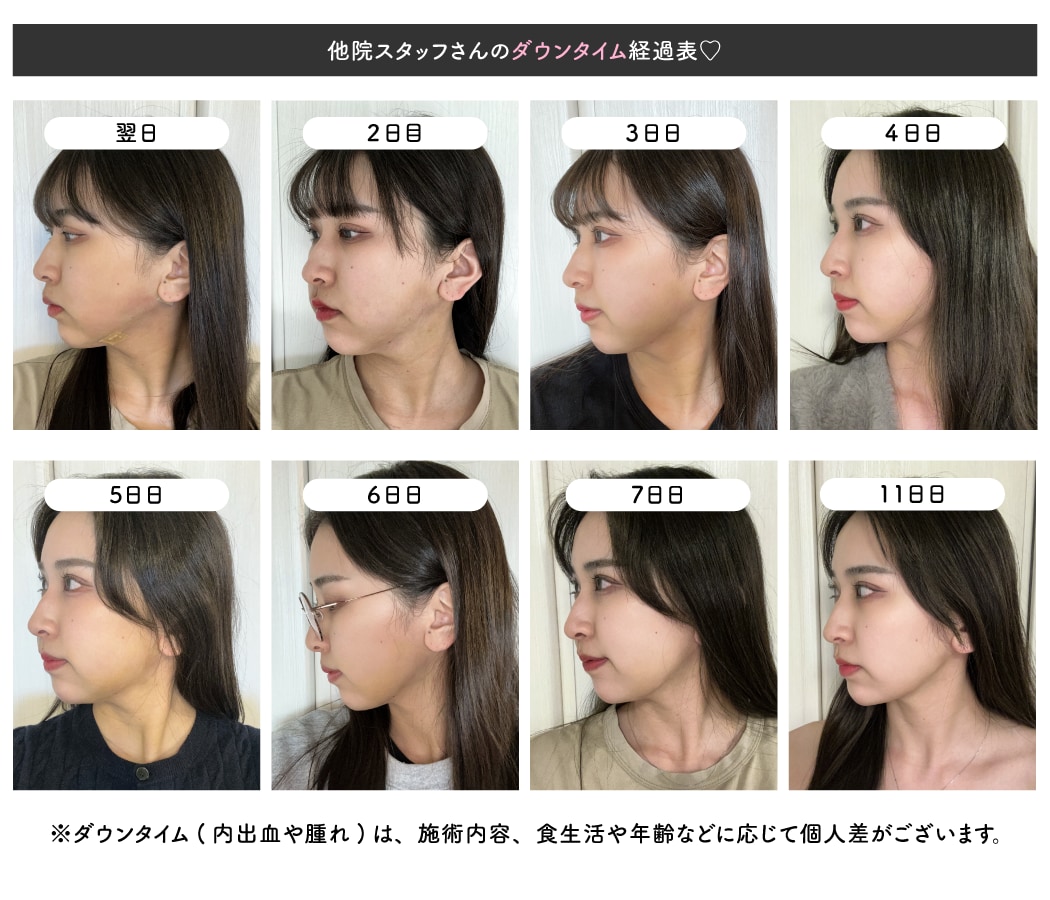 ダウンタイムが短い