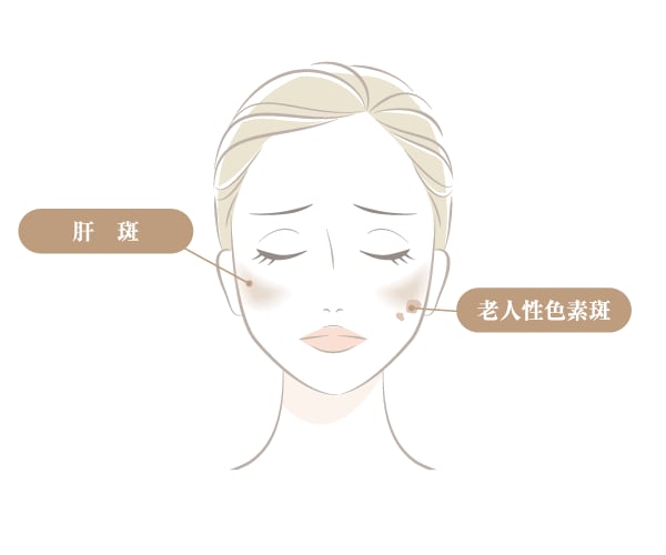 肝斑がある方は要注意？！