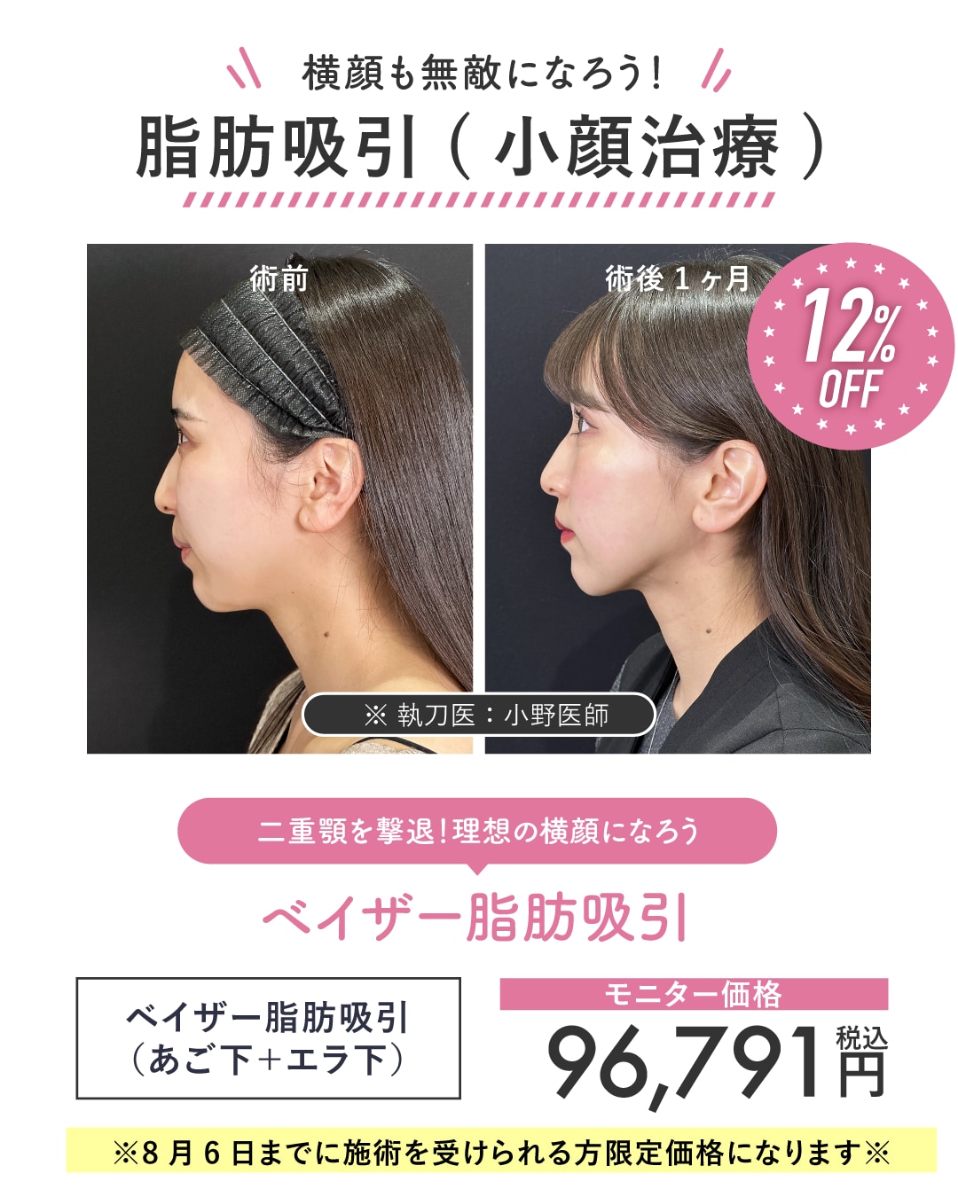顔の脂肪吸引+糸リフト(サクションリフト)