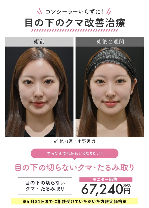 コンシーラーいらずの目元に!目の下のクマ改善治療