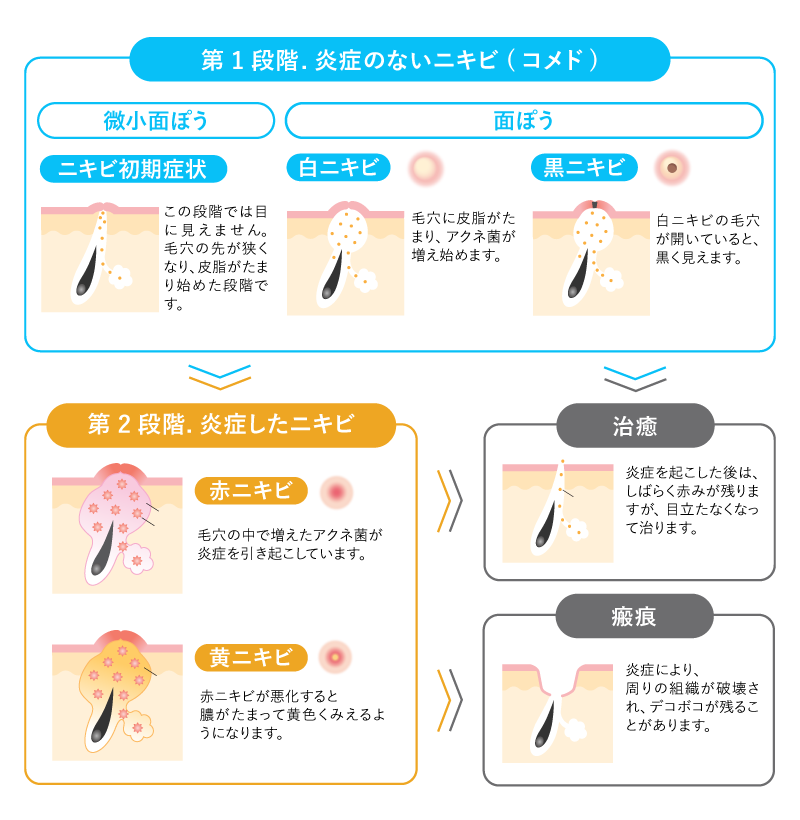 ニキビが繰り返し出来てしまう3つの原因とは？