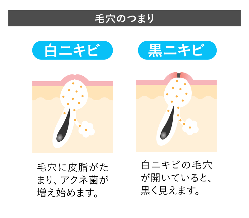 毛穴の詰まり（通気性の低下）