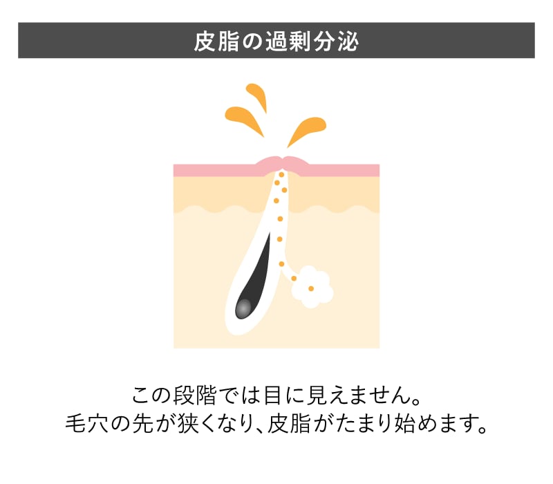 皮脂の過剰分泌