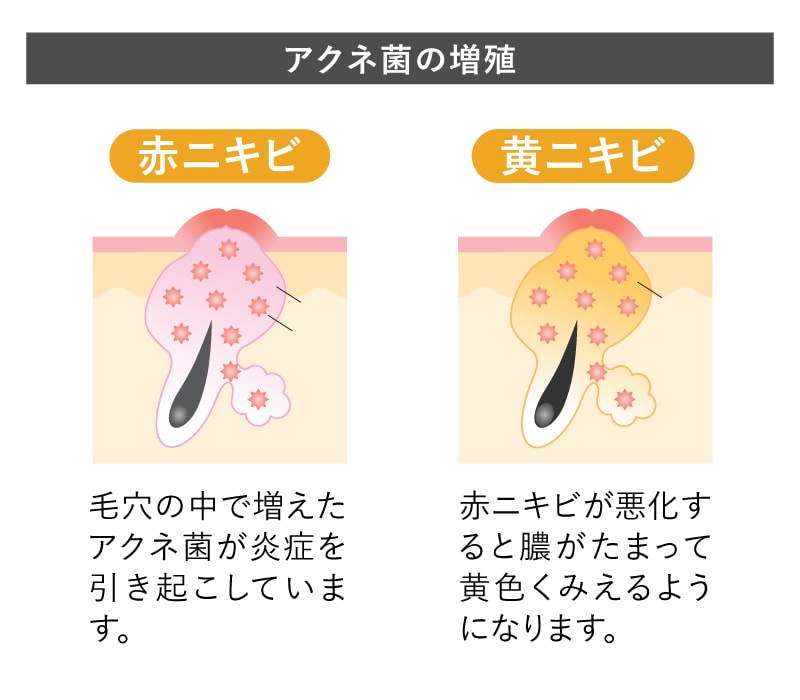 アクネ菌の増殖