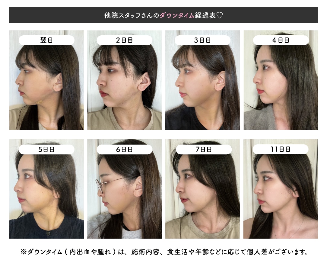 内出血・腫れはどのくらい続くの？