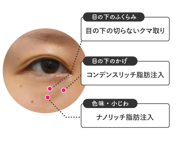 今回スタッフが受けたクマ治療はこちら