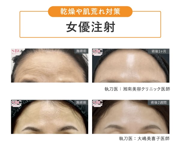 【毛穴目立ち対策】女優注射