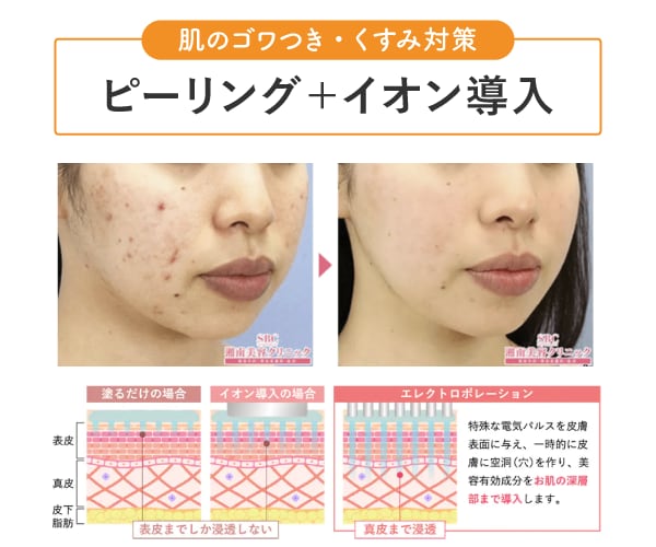 【肌のごわつき、くすみ対策】ピーリング＋イオン導入