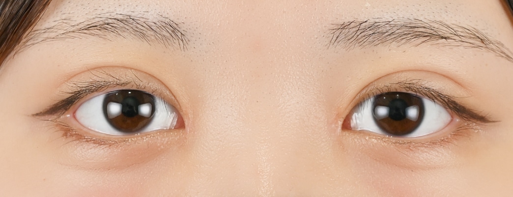 {線留めクロス法} {10代}  {女性} の術後の症例写真