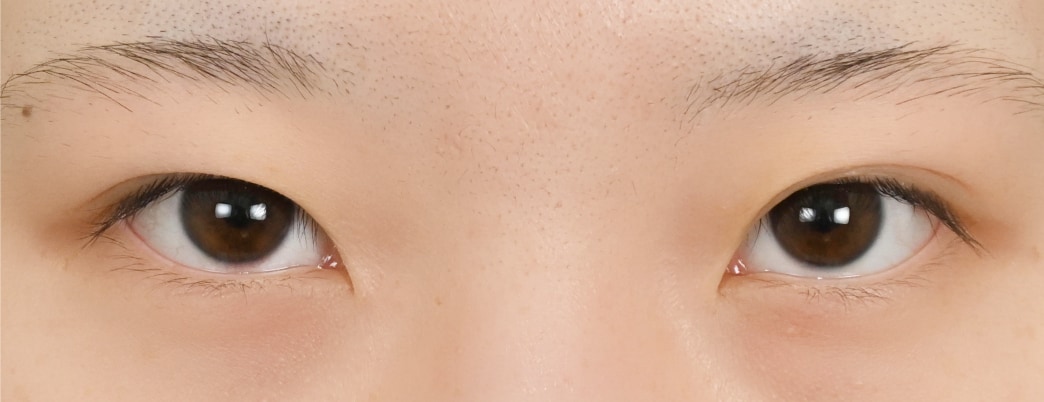 {クイックコスメティークダブルneo} {10代}  {女性} の術前の症例写真