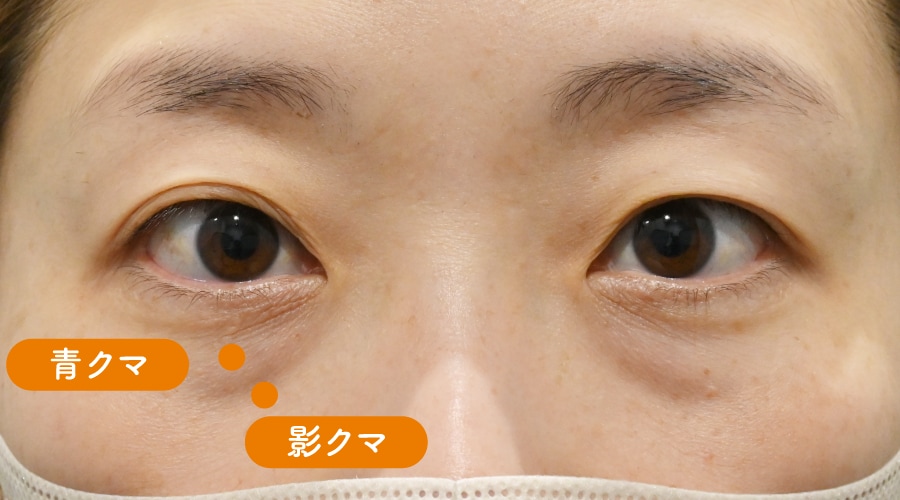 {目の下の切らないクマ取り} {30代} {女性} の術前の症例写真