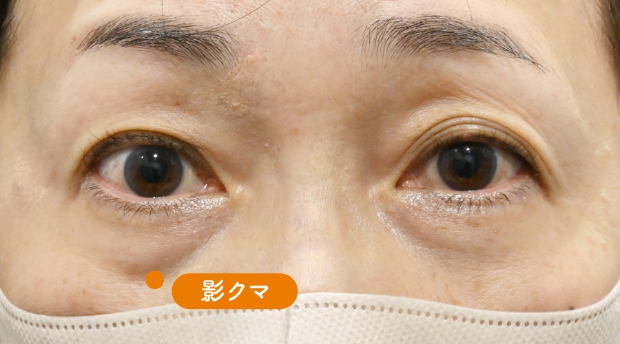 {目の下の切らないクマ取り} {50代} {女性} の術前の症例写真