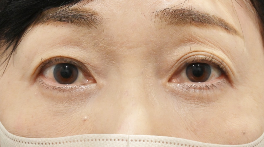 {目の下の切らないクマ取り} {50代} {女性} の術後の症例写真