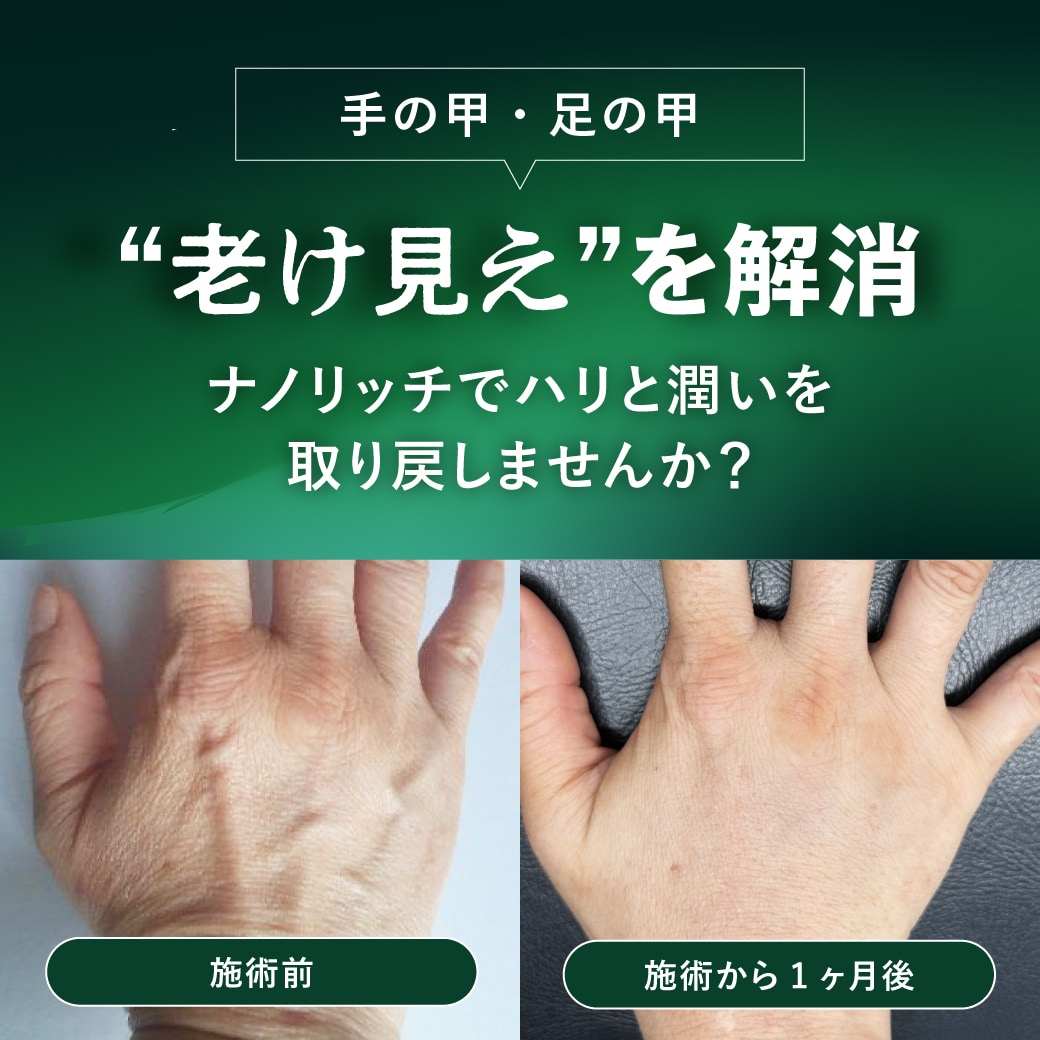 【手の甲・足の甲】「老け見え」を解消！ナノリッチでハリと潤いを取り戻す秘訣