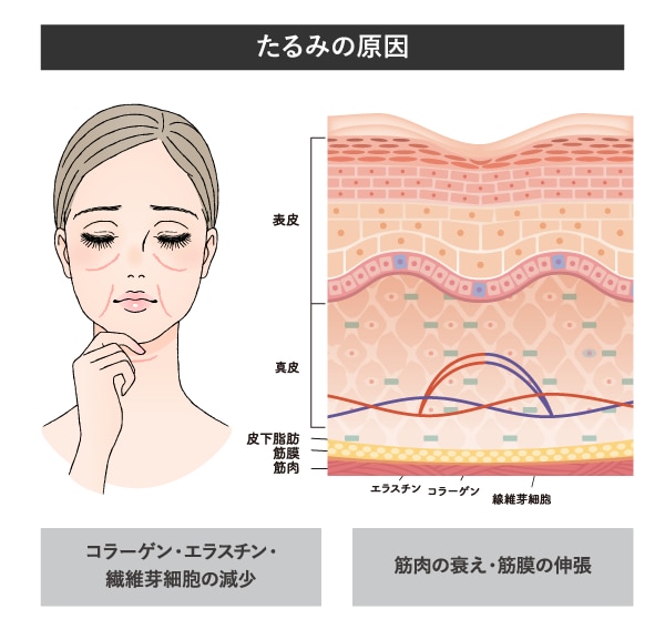 たるみの原因とは