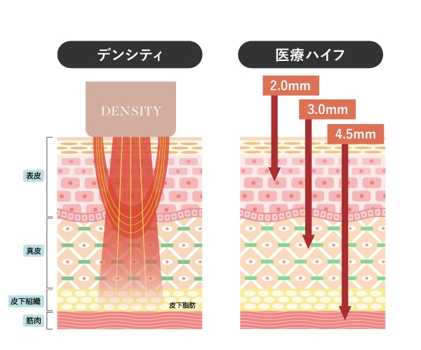 なぜデンシティとHIFUの併用がおすすめなの？