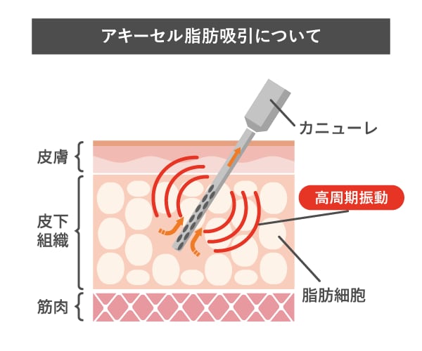 アキーセル脂肪吸引とは?