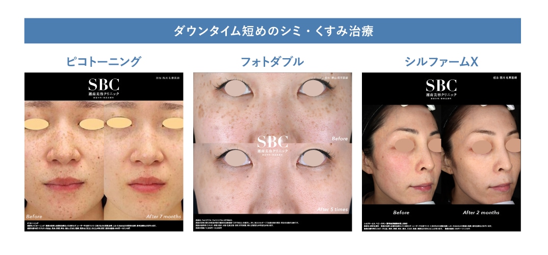 ダウンタイム短めのシミ・くすみ治療