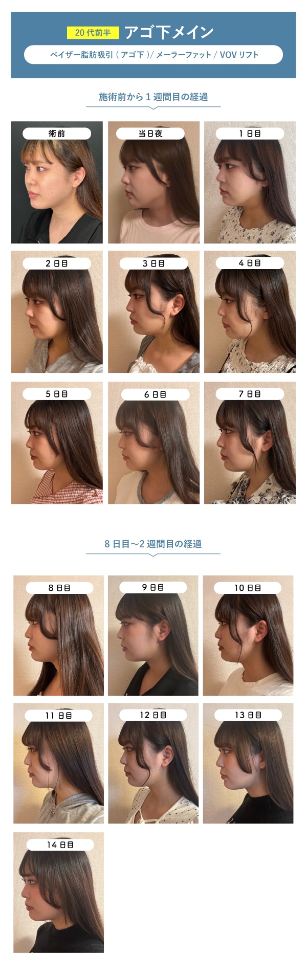 ダウンタイム　施術前〜2週間分