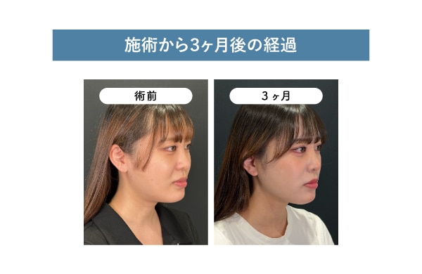 ３ヶ月目の経過