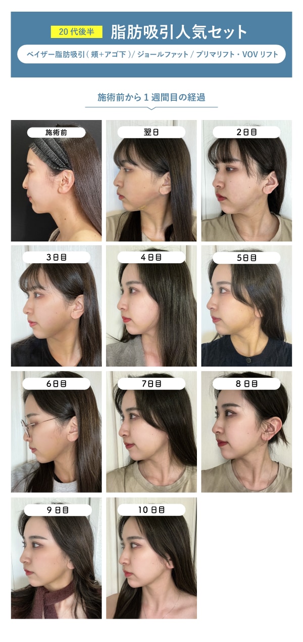 ダウンタイム　施術前〜10日間分
