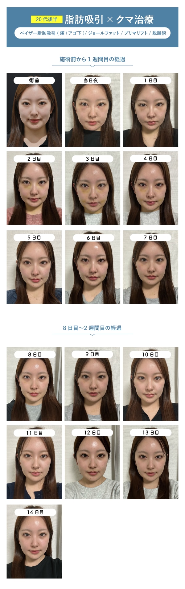 ダウンタイム　施術前〜2週間分