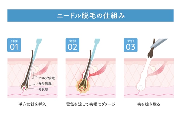 ニードル脱毛の概要
