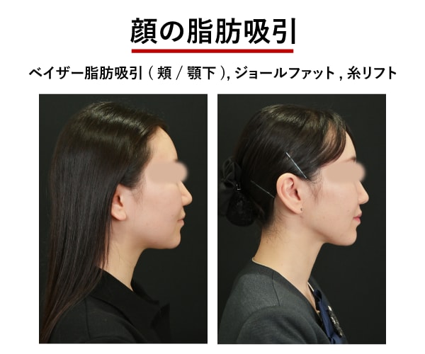 顔の脂肪吸引