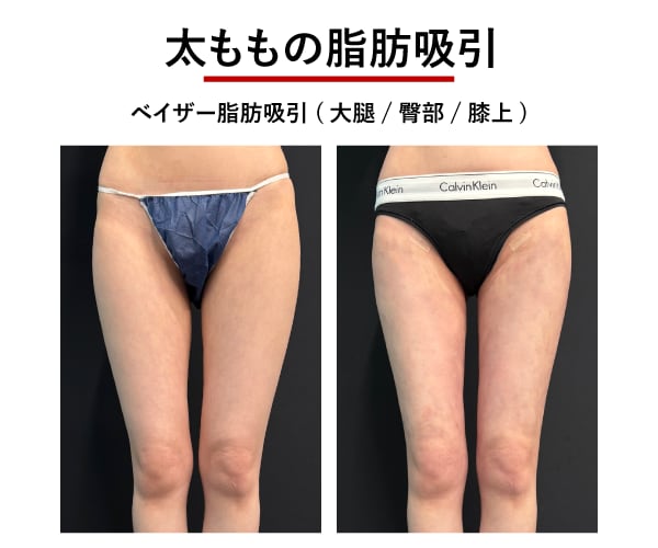 太ももの脂肪吸引