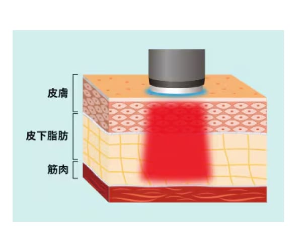 オンダリフトに期待できる小顔効果