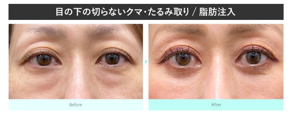 目の下のクマ治療