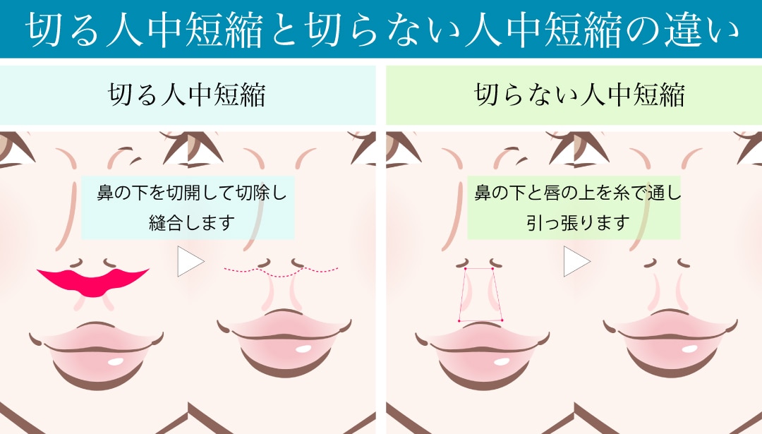 従来の人中短縮の施術と比較