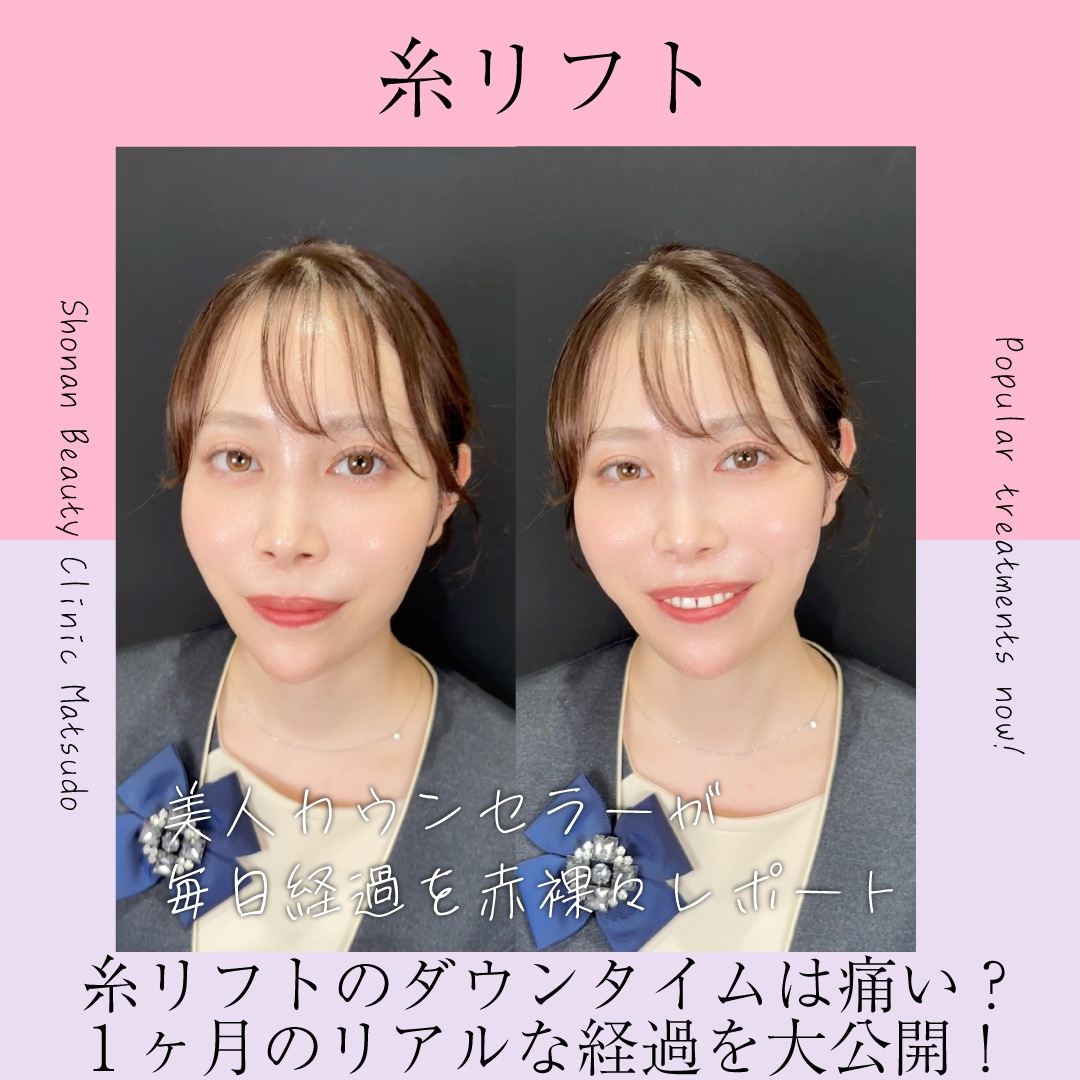 【現役カウンセラーがぶっちゃけレポート】糸リフトのダウンタイムは痛い？1ヶ月のリアルな経過を大公開！