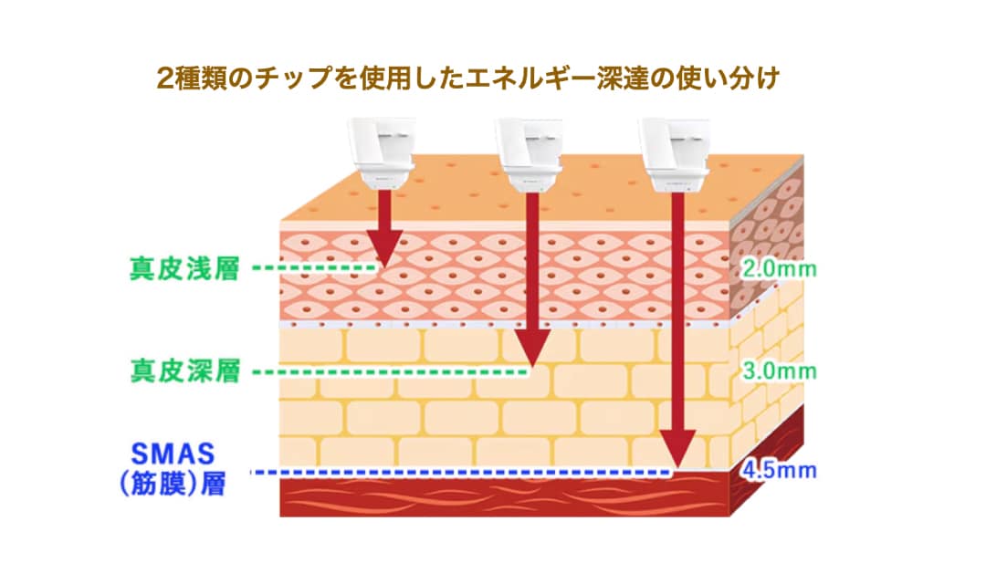 ② 点と線のW照射で叶える「たるみ引き上げ」と「肌質改善（ハイフシャワー）」