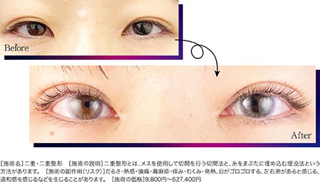 MIX型