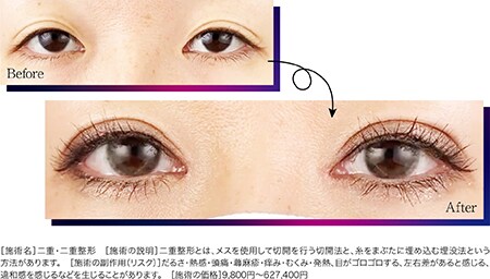 全切開法二重術 × <br />
目頭切開プレミアム