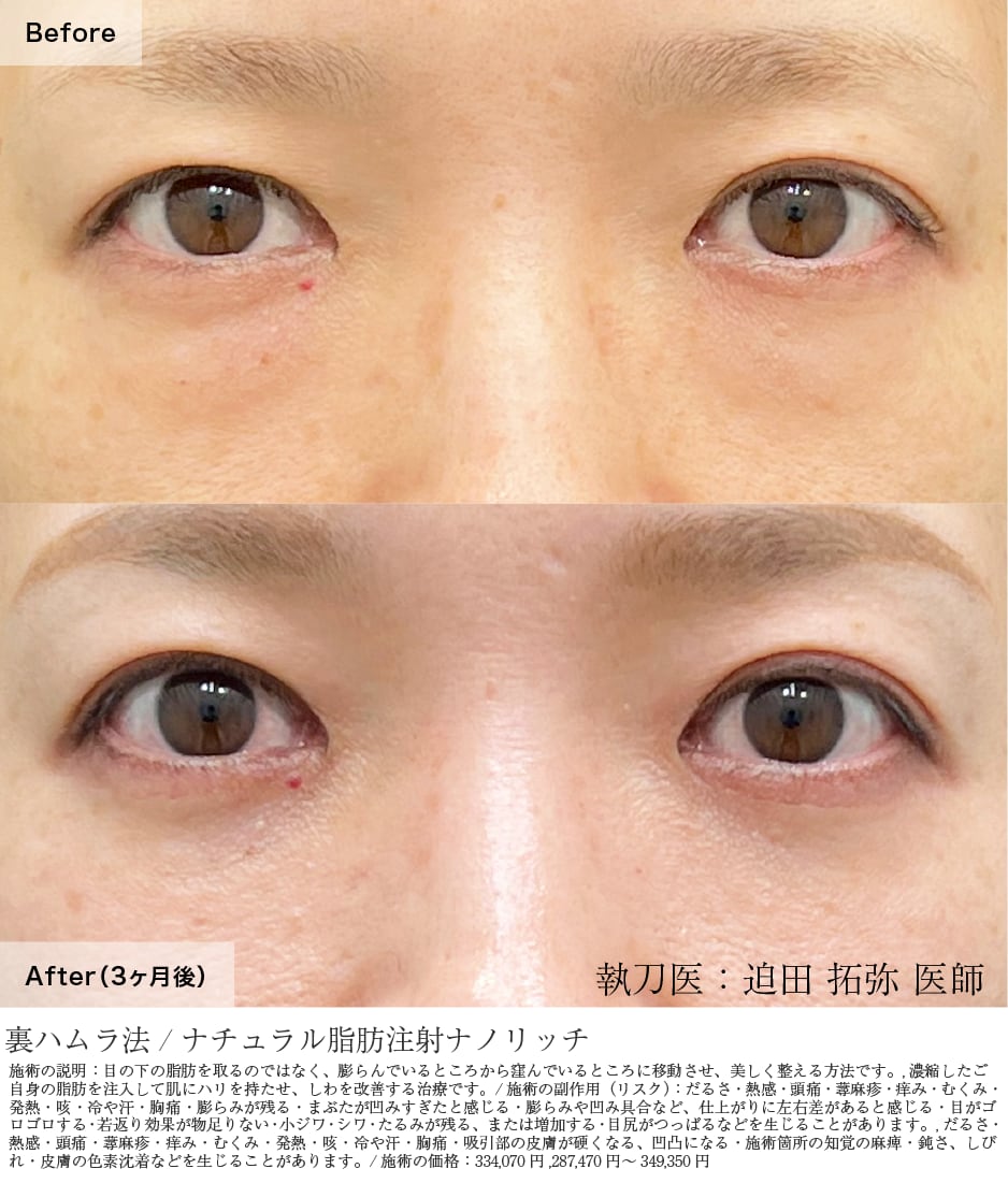 裏ハムラ法