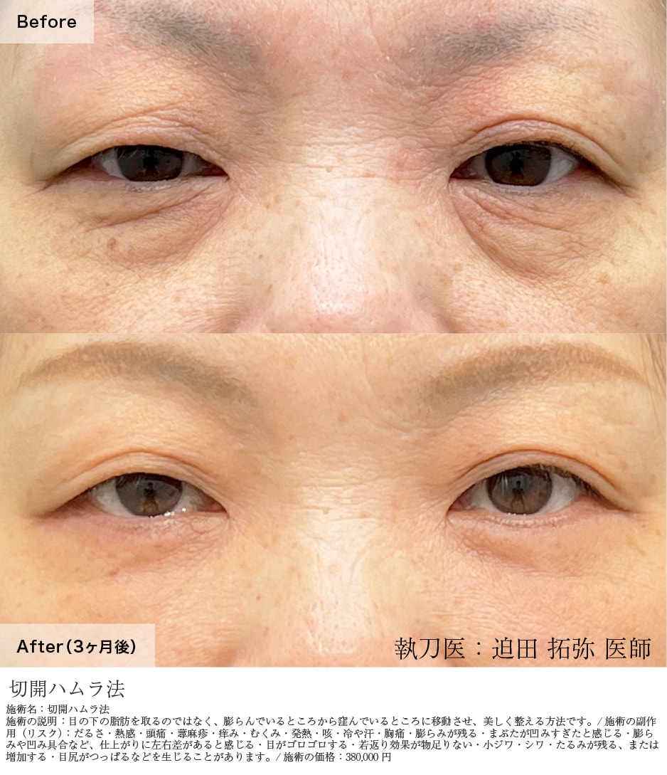 切開ハムラ法