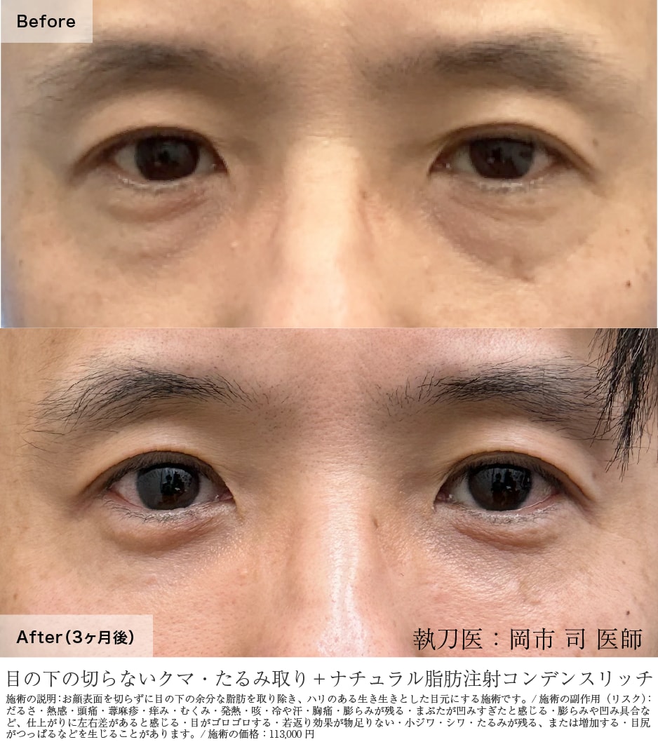 目の下の切らないクマ・たるみ（ふくらみ）取り