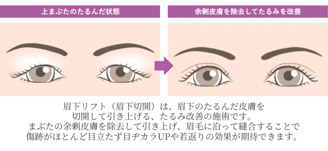 眉下リフトとは