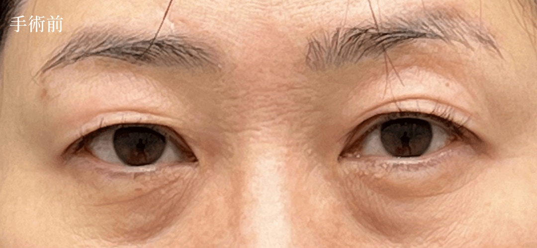 眉下症例01