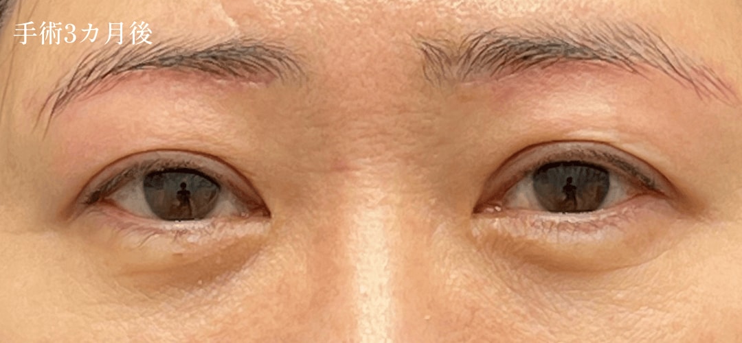 眉下症例02
