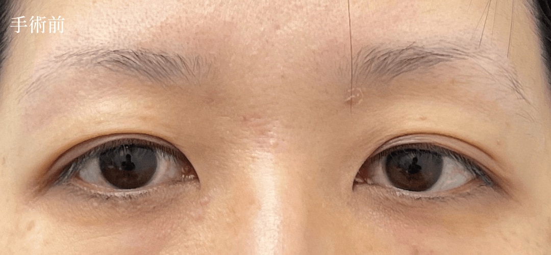 眉下症例04