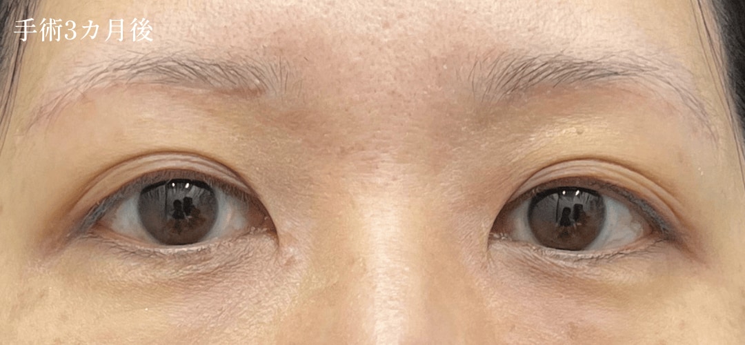 眉下症例05