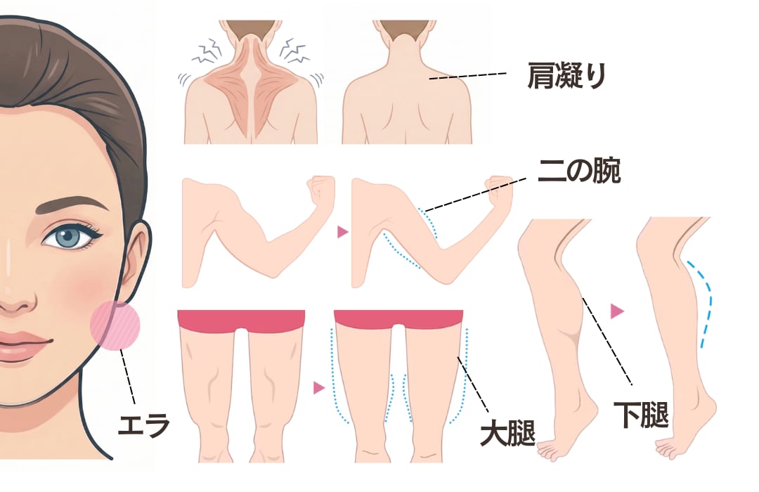 ボトックス痩身