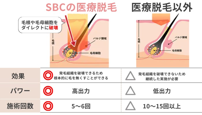 少ない施術回数で脱毛完了