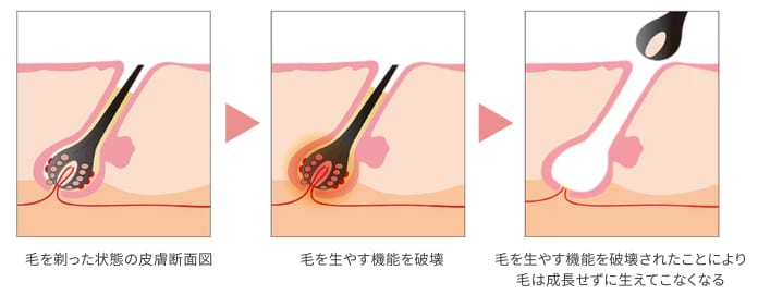 脱毛効果が高く、再度生えてこない